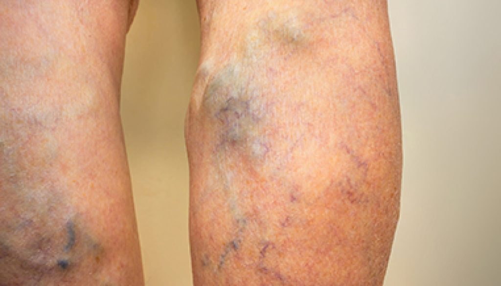 Varicose veins on a leg