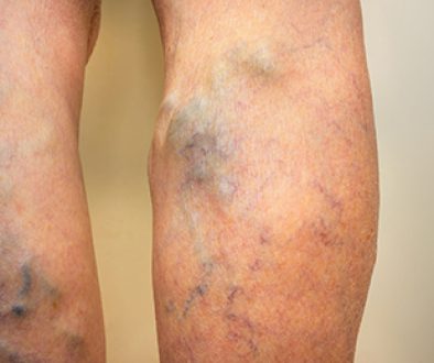 Varicose veins on a leg