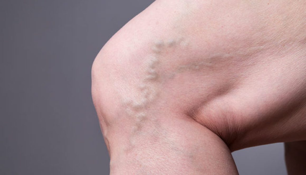 VaricoseVeins-541269710-770x533-1-650x428