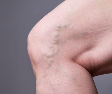 VaricoseVeins-541269710-770x533-1-650x428