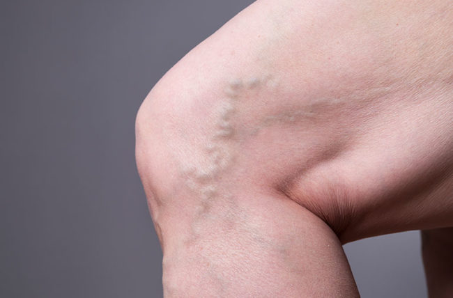 VaricoseVeins-541269710-770x533-1-650x428