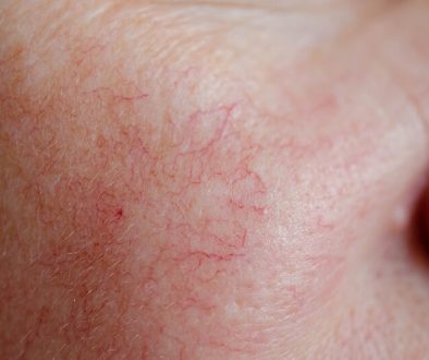 Spider-Veins-on-Cheek