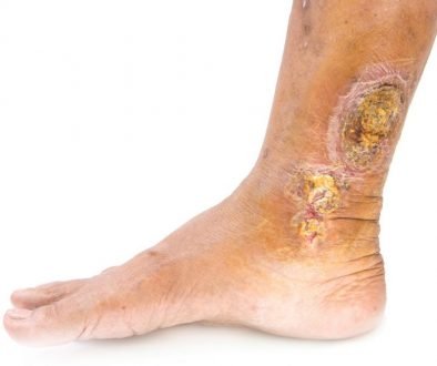 venous-leg-ulcers-e1508833041133